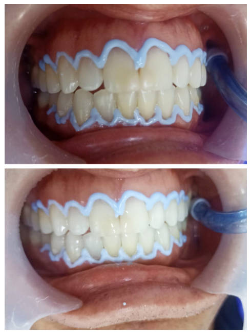 Blanqueamiento dental y aclaramiento interno