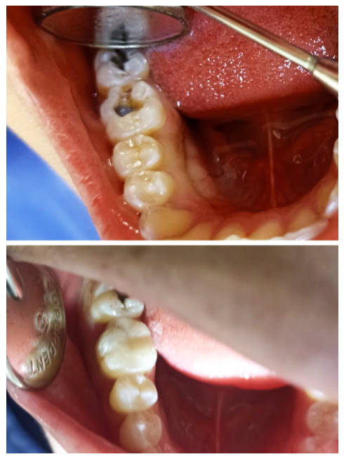 Cambio de amalgamas por resinas en dientes posteriores