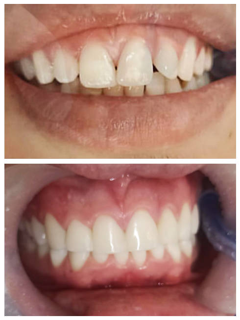 Diseño de sonrisa en resina