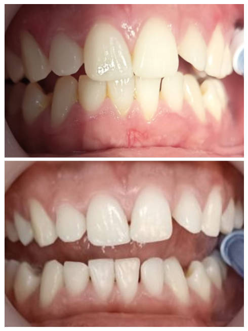 Limpieza dental profunda