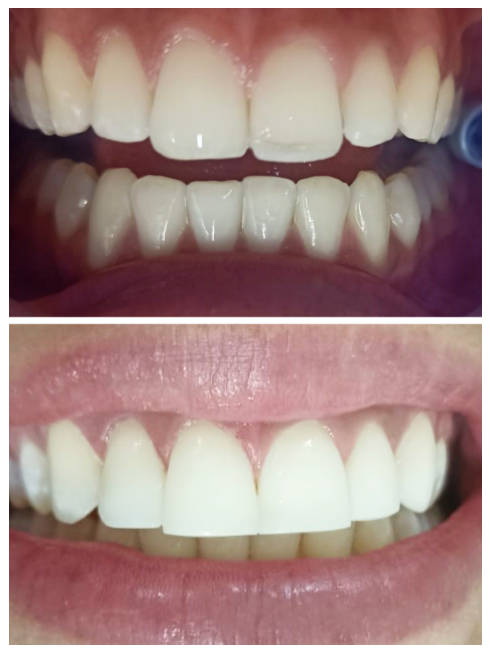 Micro diseño de sonrisa y bordes incisales