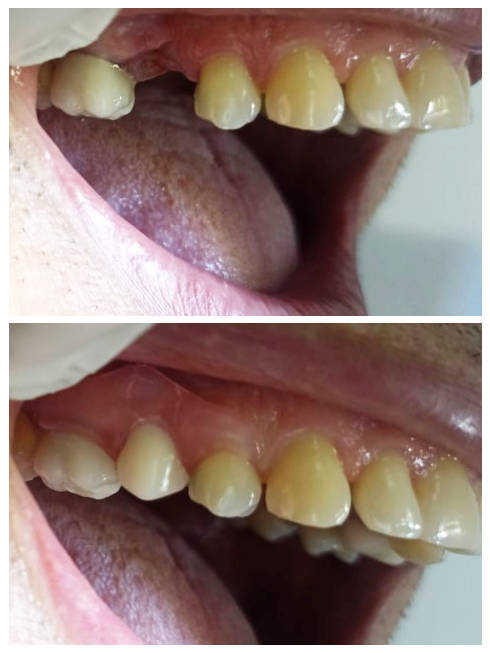 Prótesis dental parcial