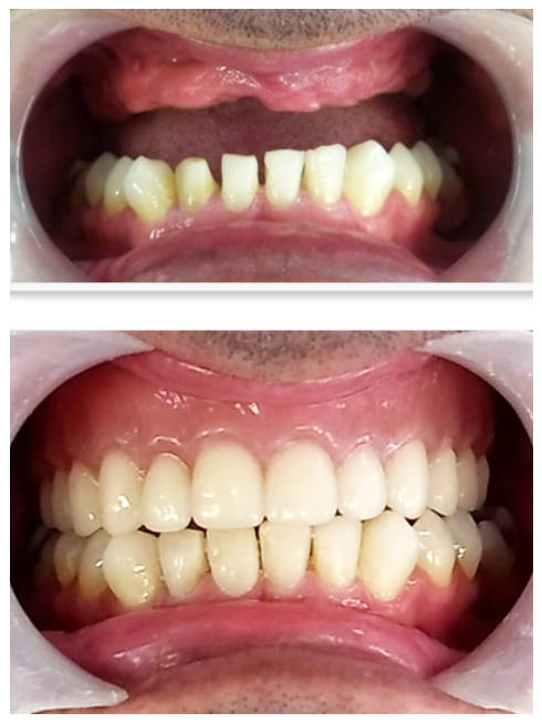 Prótesis dental removible