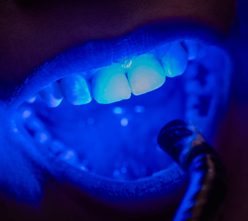 Blanqueamiento dental en Medellín: Mitos y verdades que debes conocer