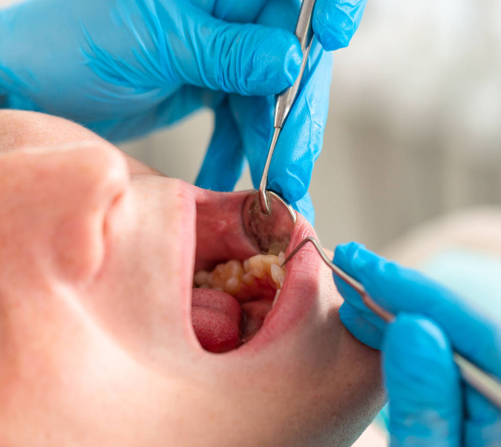 Gingivitis: ¿Por qué sangran las encías y cómo tratar la inflamación?