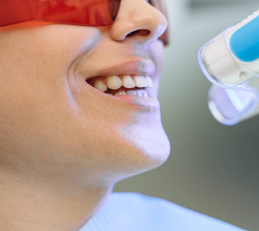 Cómo mantener una sonrisa saludable después de un blanqueamiento dental