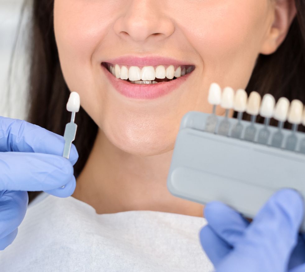 Carillas vs. resinas: ¿qué opción estética te conviene según tu caso?