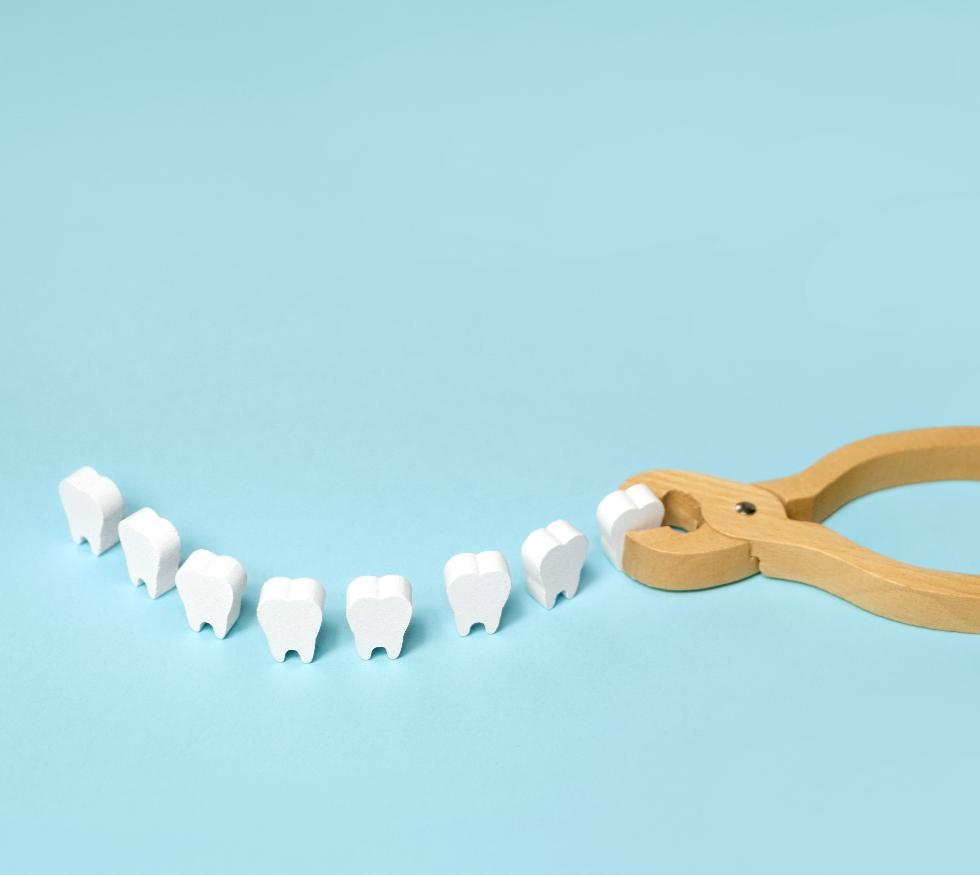 ¿Cuándo una muela del juicio debe extraerse y cuándo no?