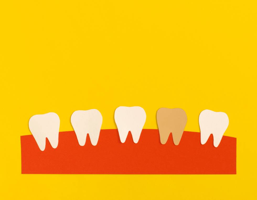 Señales tempranas de enfermedad periodontal.