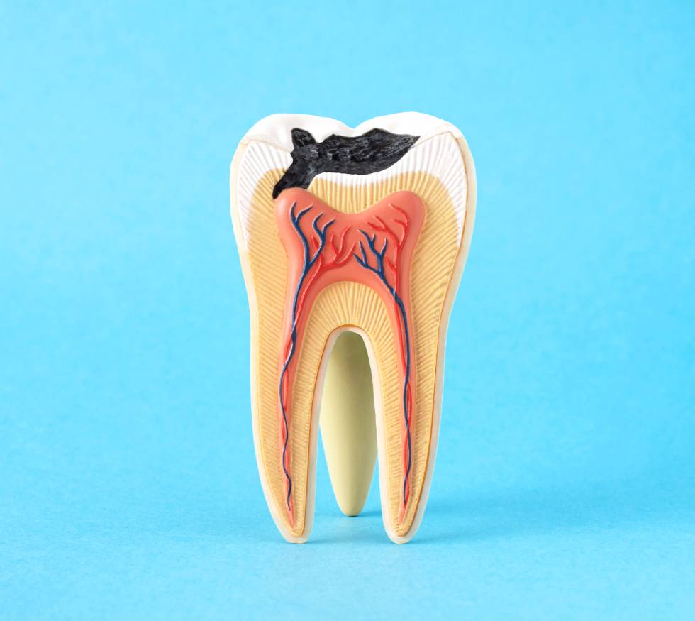 ¿Qué pasa si no tratas una caries a tiempo?