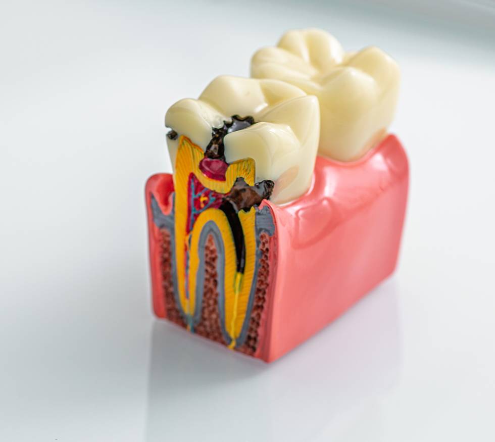 ¿Por qué algunas personas tienen más caries que otras?
