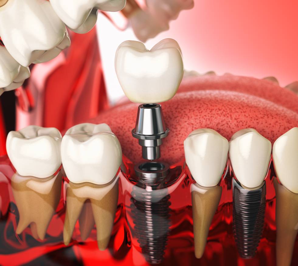 ¿Cómo saber si necesitas un implante dental?